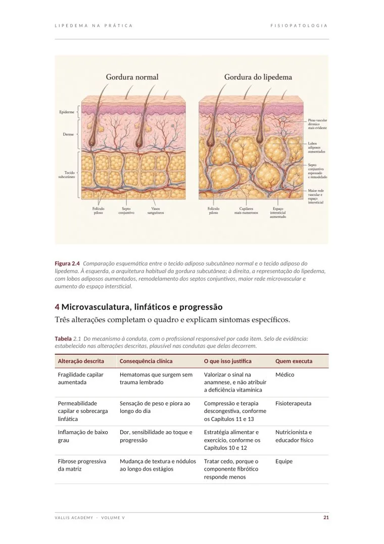 Prévia de página real de Lipedema na Prática: Fisiopatologia · figura e tabela